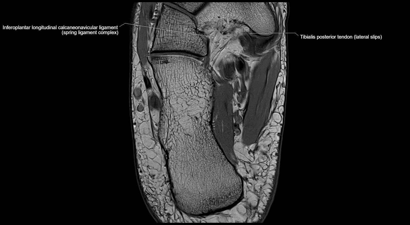 MRI ankle ligaments anatomy axial 3T image 22.webp